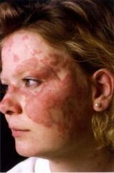 Study lays groundwork for refractory cutaneous lupus treatment algorithms